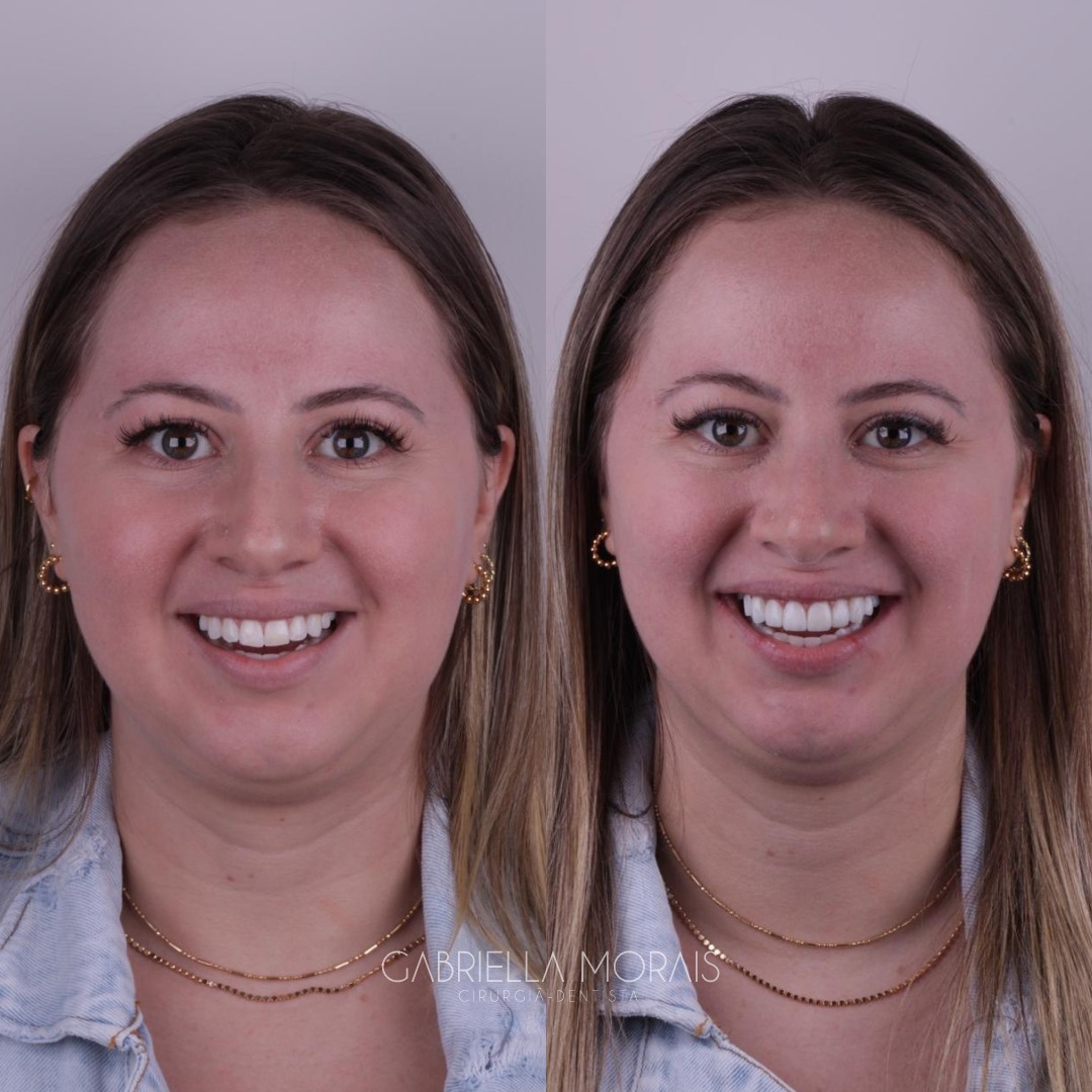 Caso 6 - Antes e Depois